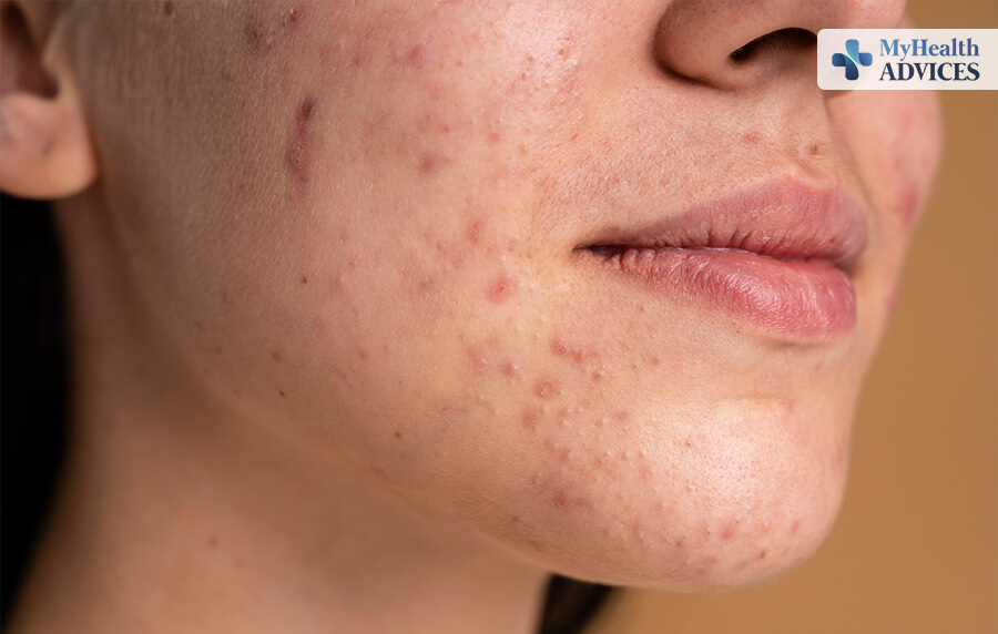 Acne: Signs, Symptoms, Causes, Prevention