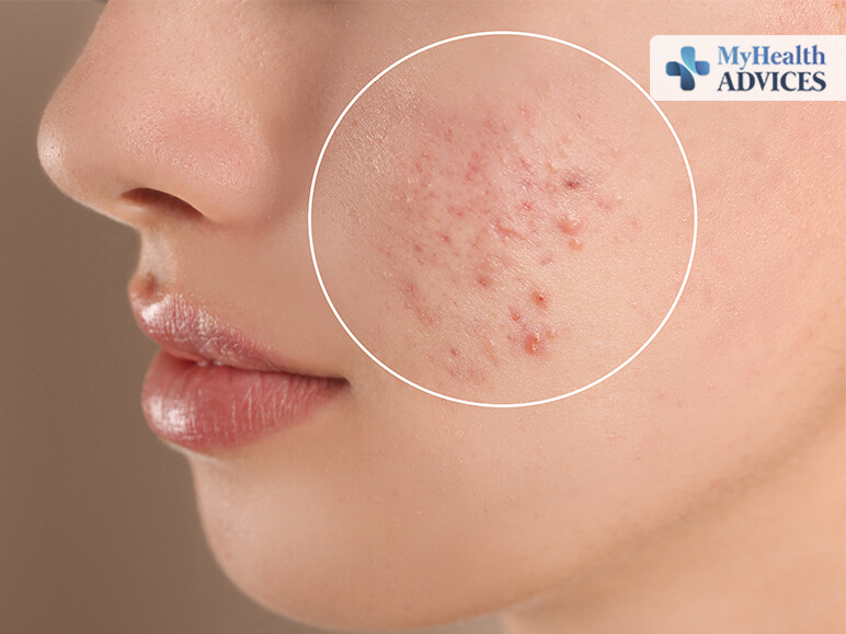 Acne Prone Areas