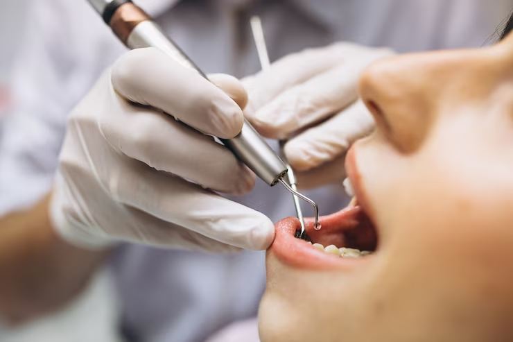 How Long Should You Wait To Exercise After Tooth Extraction